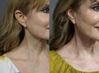 Before and after Laser Coring (Poke A Dot Lift®) case 36104 - Angle 2