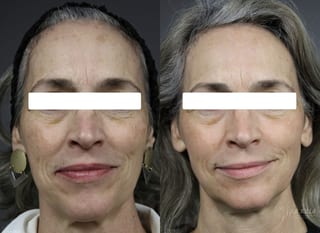 Before and after Fraxel® case 36111 - Angle 1