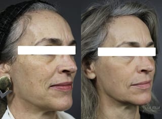 Before and after Fraxel® case 36111 - Angle 2