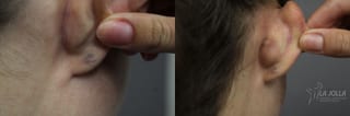 Before and after StarWalker® Laser case 36112 - Angle 2