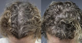 Before and after Laser Hair Growth case 36113 - Angle 1