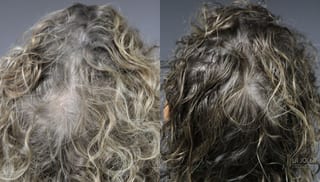 Before and after Laser Hair Growth case 36113 - Angle 2