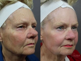 Before and after Laser for Rhinophyma case 36114 - Angle 1