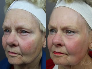 Before and after Laser for Rhinophyma case 36114 - Angle 2