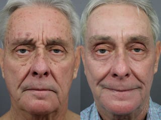 Before and after SP Dynamis case 36115 - Angle 1
