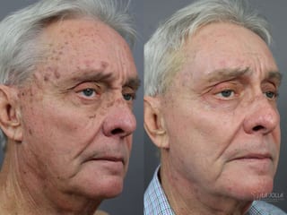 Before and after SP Dynamis case 36115 - Angle 2
