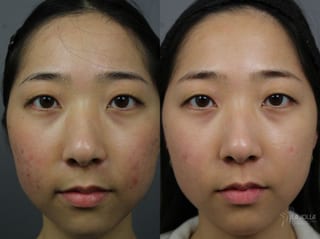 Before and after Fraxel® case 36117 - Angle 1