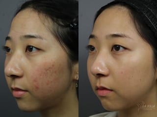 Before and after Fraxel® case 36117 - Angle 2