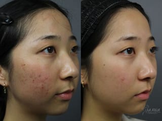 Before and after Fraxel® case 36117 - Angle 3