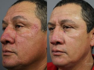 Before and after VBeam case 36118 - Angle 1
