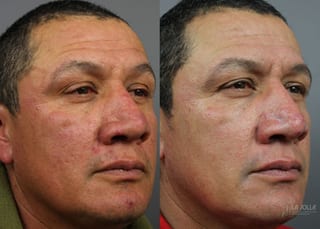 Before and after VBeam case 36118 - Angle 2