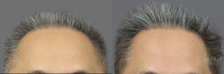 Before and after Hair Restoration case 36119 - Angle 2