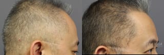 Before and after Hair Restoration case 36119 - Angle 3