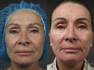 Before and after Ablative Laser Treatment case 36120 - Angle 1