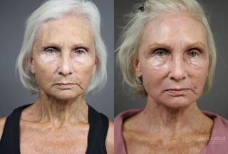 Before and after Fractional CO2 case 36122 - Angle 1
