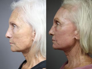Before and after Fractional CO2 case 36122 - Angle 2