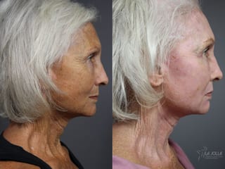 Before and after Fractional CO2 case 36122 - Angle 3