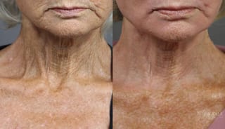 Before and after Fractional CO2 case 36122 - Angle 4