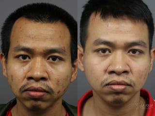 Before and after Acne: Laser Treatment case 36124 - Angle 1