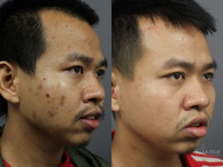 Before and after Acne: Laser Treatment case 36124 - Angle 2