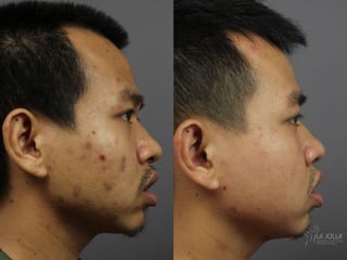 Before and after Acne: Laser Treatment case 36124 - Angle 3