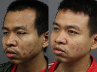 Before and after Acne: Laser Treatment case 36124 - Angle 4