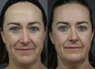 Before and after Fraxel® case 36129 - Angle 1