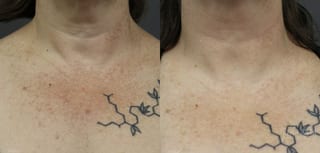 Before and after Fraxel® case 36129 - Angle 2
