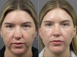 Before and after ResurFX case 36133 - Angle 1