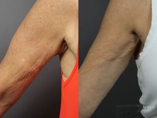 Before and after Radiesse® case 36134 - Angle 1