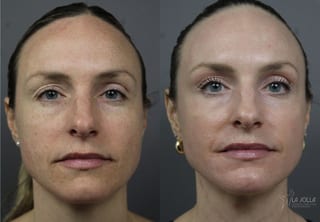 Before and after Fractional CO2 case 36135 - Angle 1