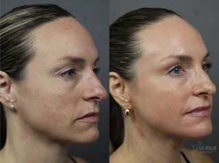Before and after Fractional CO2 case 36135 - Angle 2