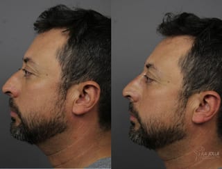 Before and after Nose Filler case 36136 - Angle 1