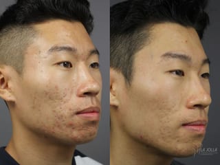 Before and after Acne: Laser Treatment case 36137 - Angle 2