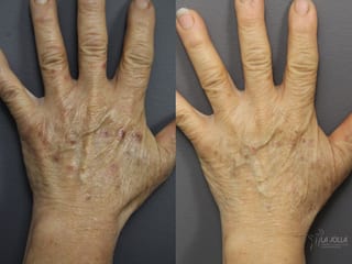 Before and after Hand Rejuvenation case 36138 - Angle 2
