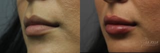 Before and after Lip Filler case 36139 - Angle 1