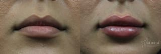 Before and after Lip Filler case 36139 - Angle 2
