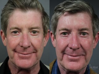 Before and after Sculptra® case 36140 - Angle 1