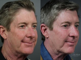 Before and after Sculptra® case 36140 - Angle 3
