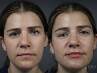 Before and after Lip Filler case 36141 - Angle 1