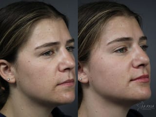 Before and after Lip Filler case 36141 - Angle 2