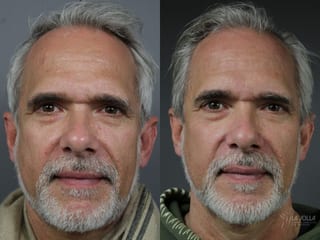 Before and after Sculptra® case 36142 - Angle 1