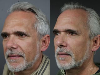 Before and after Sculptra® case 36142 - Angle 2