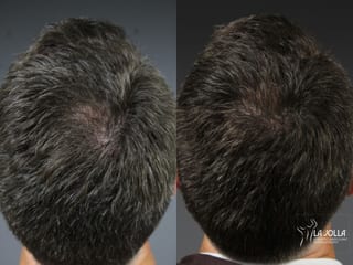 Before and after Laser Hair Growth case 36144 - Angle 1