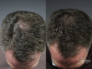 Before and after Laser Hair Growth case 36144 - Angle 2