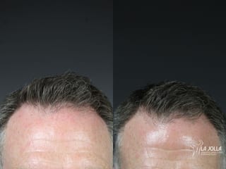 Before and after Laser Hair Growth case 36144 - Angle 5