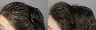 Before and after PRP (Platelet-Rich Plasma) case 36154 - Angle 1