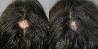 Before and after PRP (Platelet-Rich Plasma) case 36154 - Angle 2