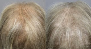 Before and after Laser Hair Growth case 36155 - Angle 1