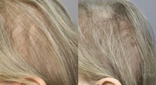 Before and after Laser Hair Growth case 36155 - Angle 3